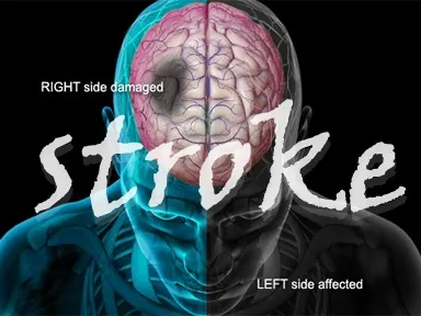 Stroke